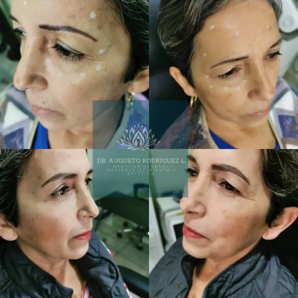 botox